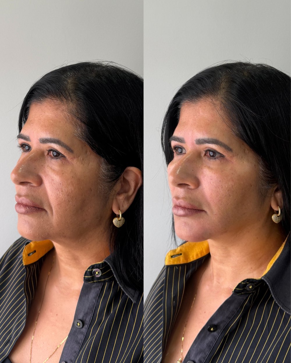 Resultado antes e depois de paciente da Volie Clinic — caso 4
