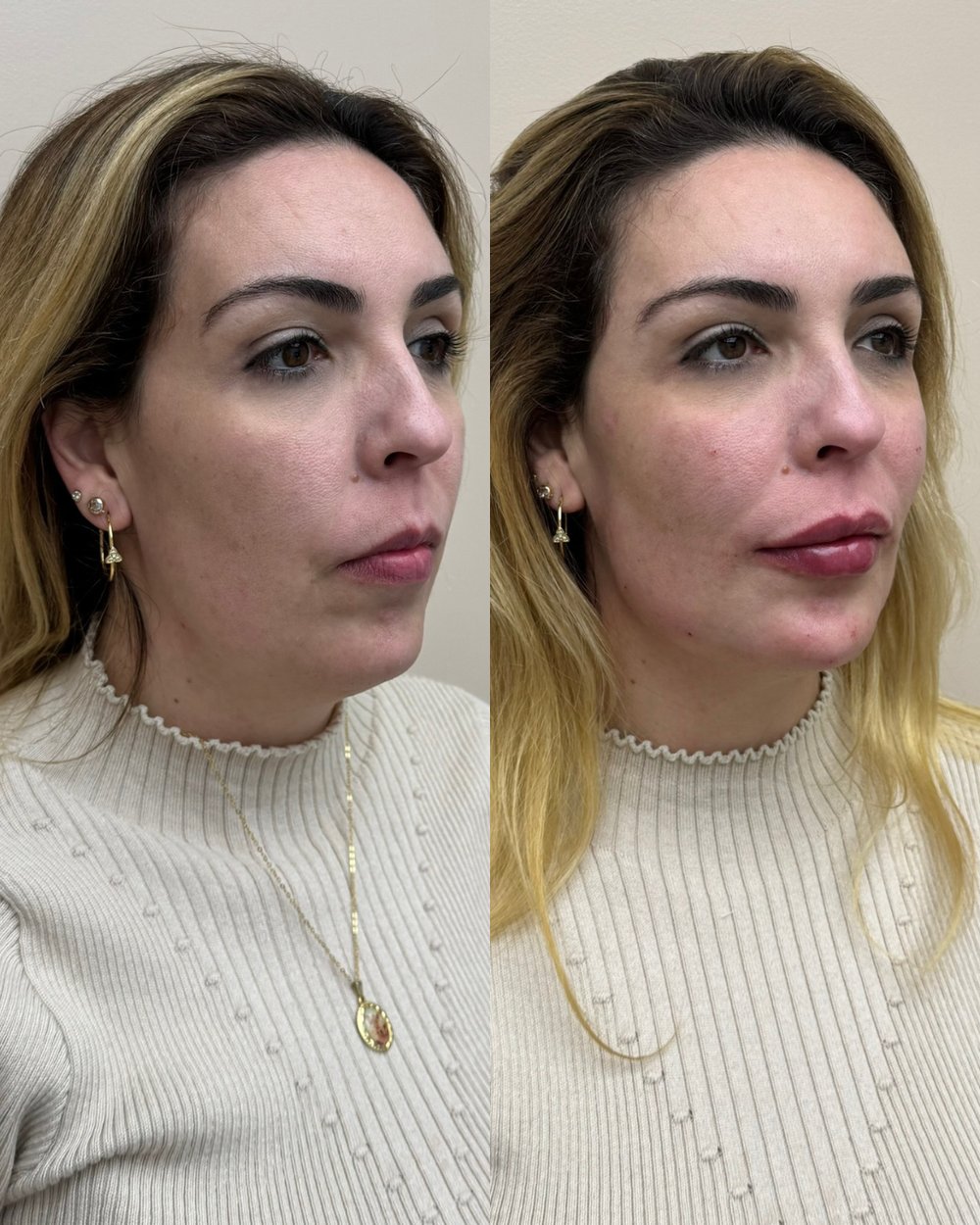 Resultado antes e depois de paciente da Volie Clinic — caso 2
