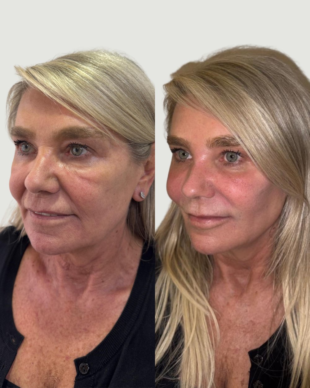 Resultado antes e depois de paciente da Volie Clinic — caso 6
