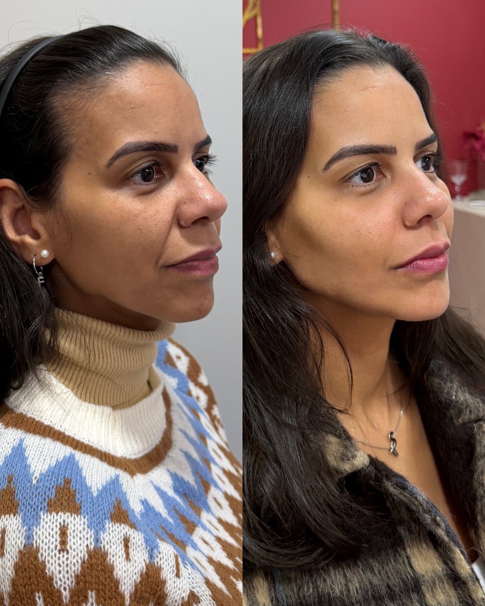 Resultado antes e depois de paciente da Volie Clinic — caso 1