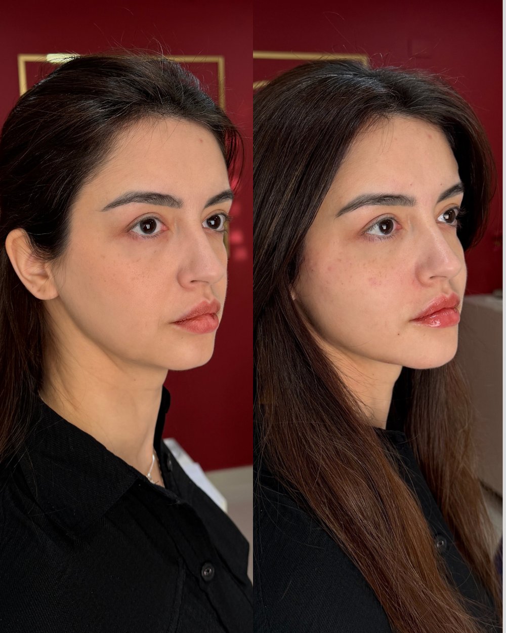 Resultado antes e depois de paciente da Volie Clinic — caso 3