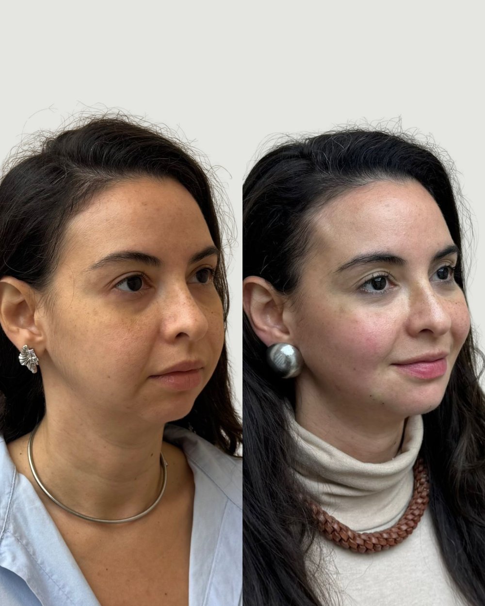 Resultado antes e depois de paciente da Volie Clinic — caso 8
