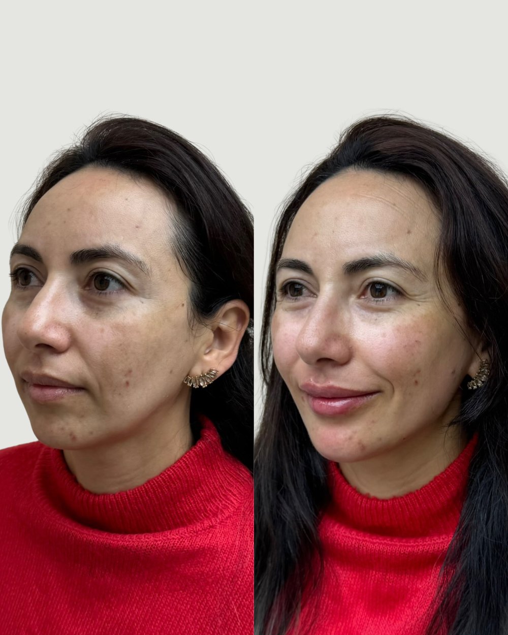 Resultado antes e depois de paciente da Volie Clinic — caso 7