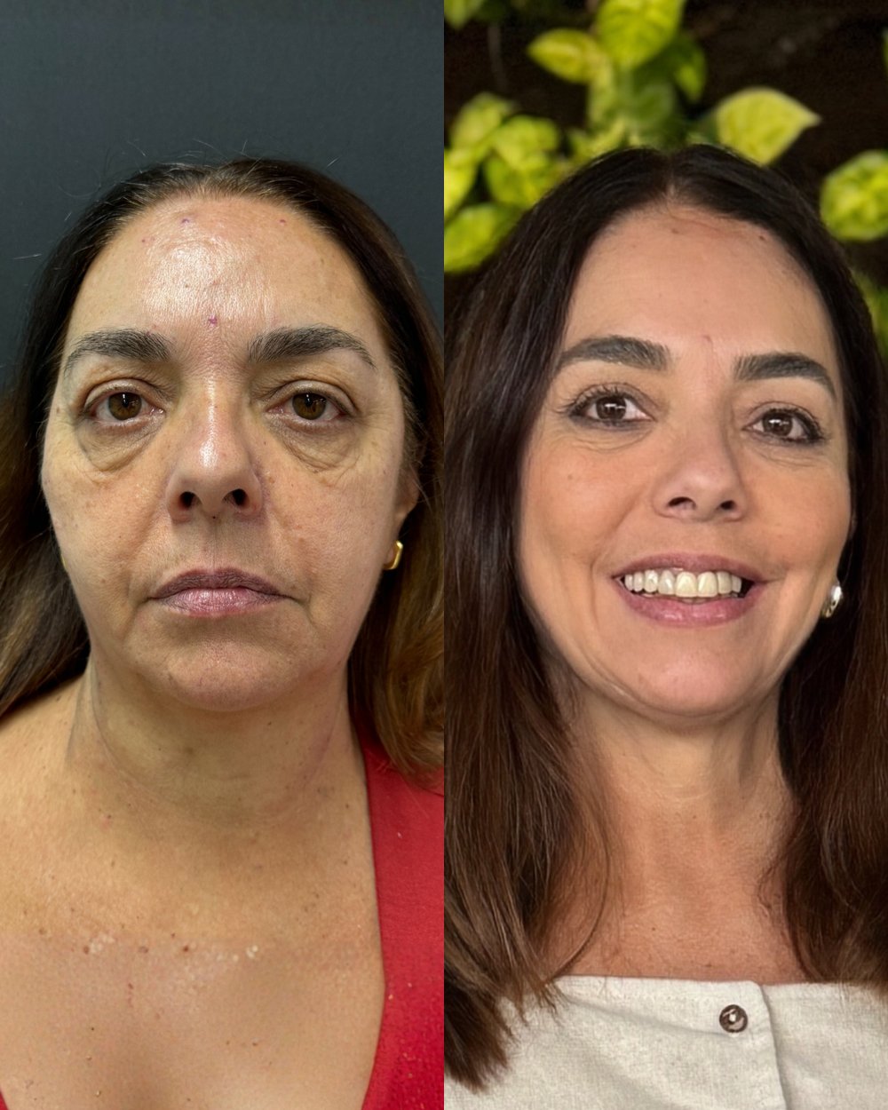 Resultado antes e depois de paciente da Volie Clinic — caso 5